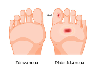 Diabetická noha patrí medzi najčastejšie a najzávažnejšie komplikácie cukrovky. Ide o stav, ktorý vzniká v dôsledku poškodenia nervov (polyneuropatia) a zhoršenej cirkulácie v dolných končatinách. Ak sa nelieči včas, môže viesť k infekciám, vredom a v extrémnych prípadoch aj k amputácii. U diabetikov 2. typu, s cukrovkou dlhšie ako 10 rokov, štatistiky uvádzajú až 50% výskyt polyneuropatie nôh