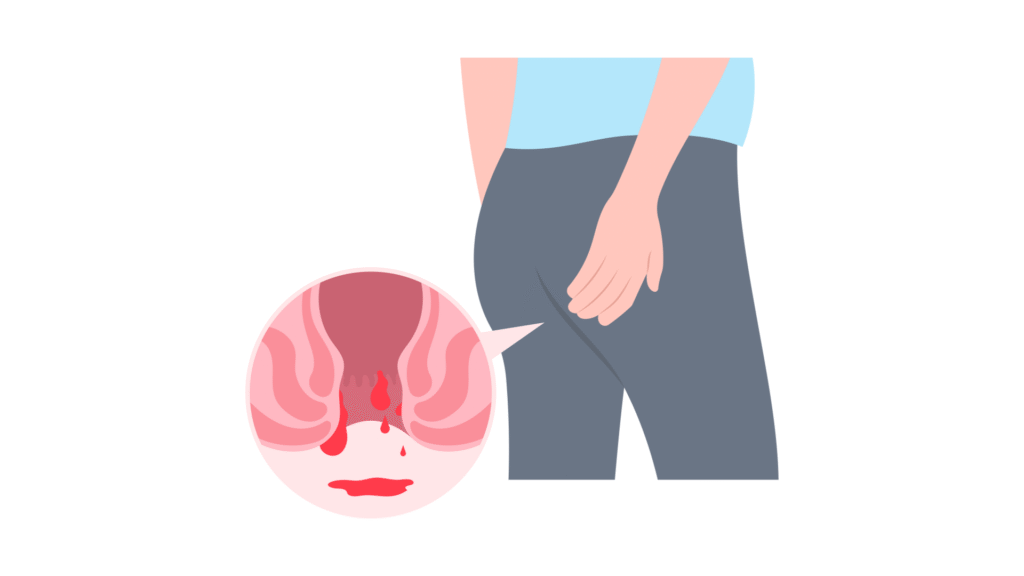 Hemoroidy sú častým problémom, ktorý prináša bolesť, opuch, zápal a krvácanie.
Mnohí pacienti volia chirurgický zákrok ako riešenie, avšak ani operácia nie vždy zaručí trvalé odstránenie problému
