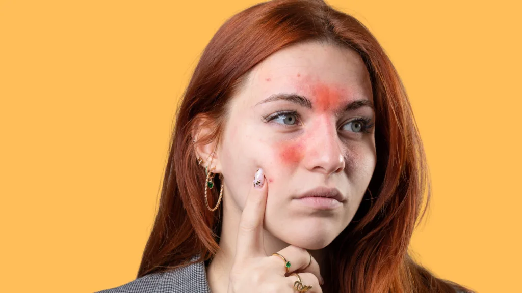 skin_redness