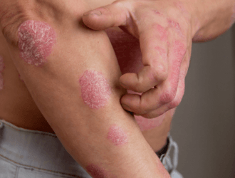 Lupienka a psoriáza: Nenechajte sa už obmedzovať a siahnite po dermanutraceutiku!