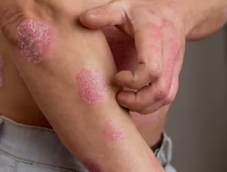 Lupienka a psoriáza: Nenechajte sa už obmedzovať a siahnite po dermanutraceutiku!