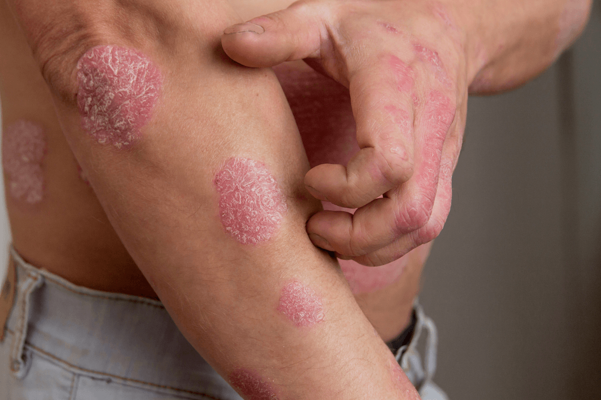 Lupienka a psoriáza: Nenechajte sa už obmedzovať a siahnite po dermanutraceutiku!
