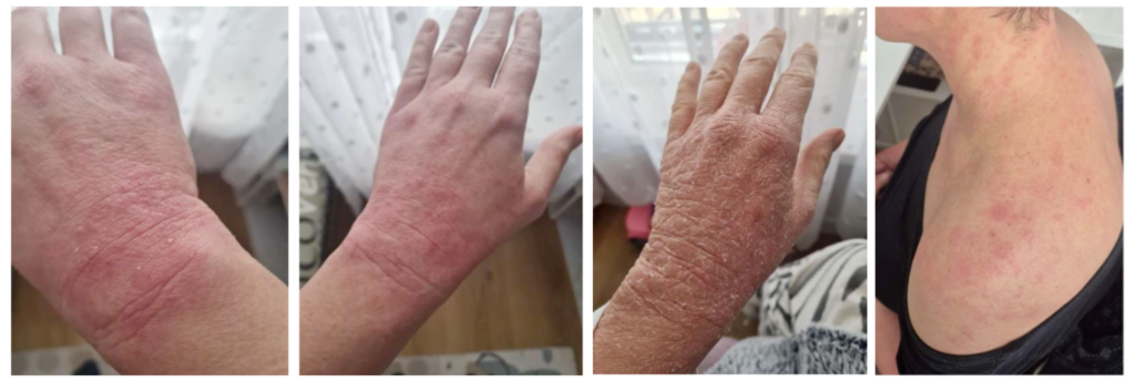 eczema
