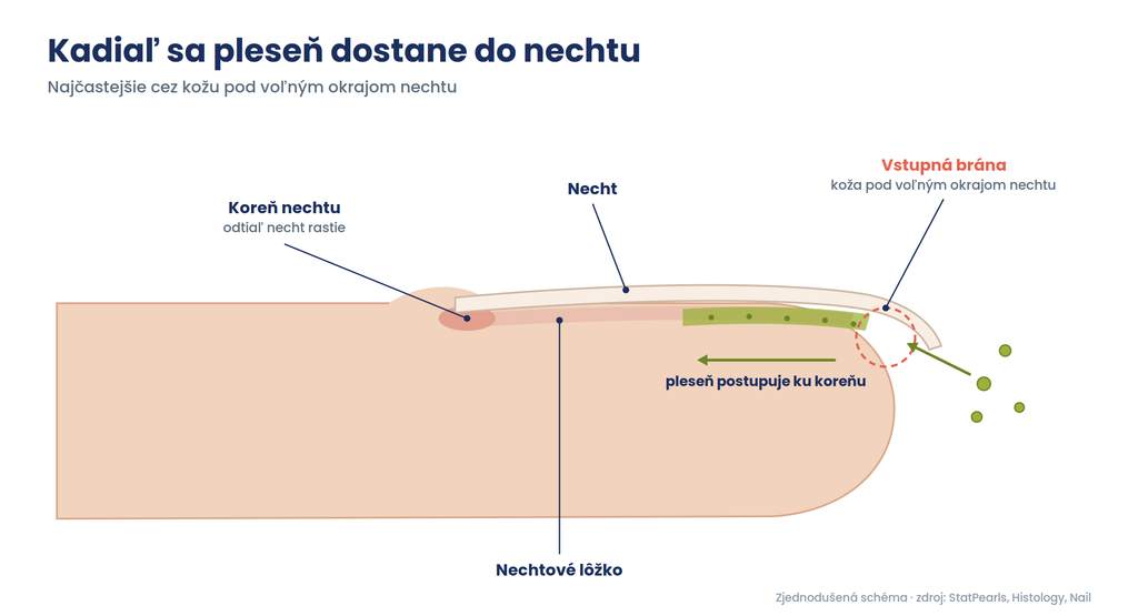 Schéma prsta s nechtom: pleseň vniká cez kožu pod voľným okrajom nechtu a postupuje pod nechtom smerom ku koreňu